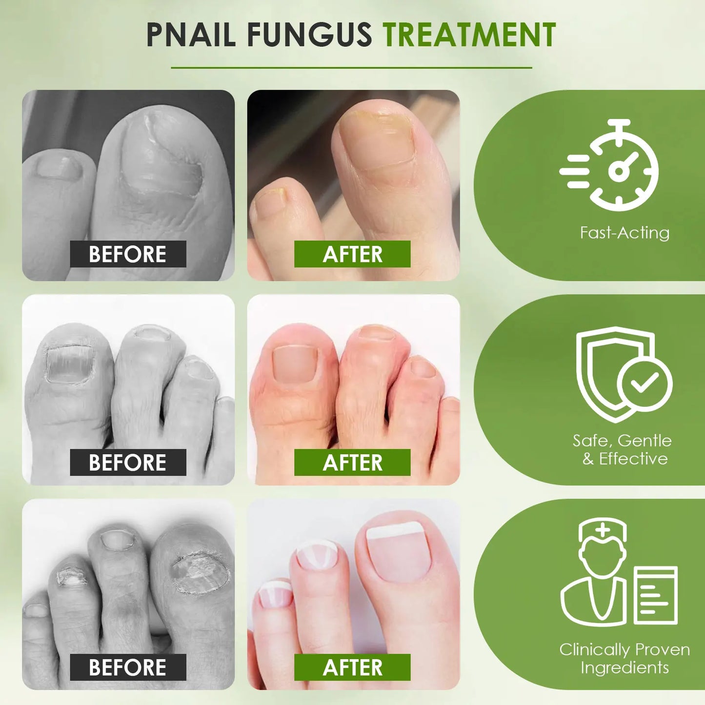 1 Box/4pcs Nail Fungal Liquid Fast Onychomycosis Fungus Nails